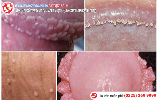 Thịt thừa vùng kín nam, nữ là bị bệnh gì?