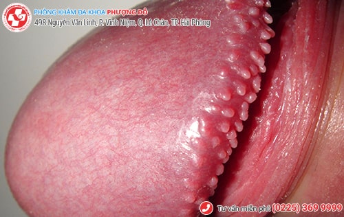 Thịt thừa vùng kín nam, nữ là bị bệnh gì?