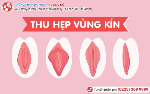 Phương pháp thu hẹp vùng kín không đau, chị em đã biết chưa?