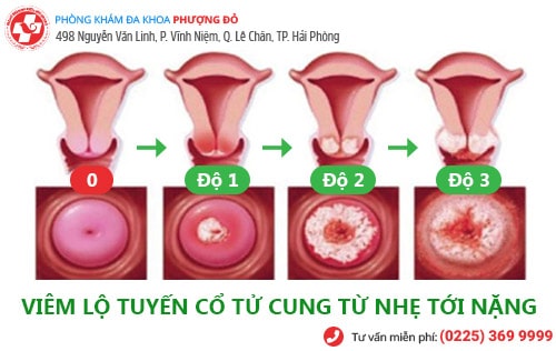 Thuốc trị viêm lộ tuyến loại nào tốt?