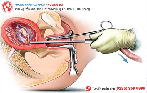 Tổng hợp các phương pháp bỏ thai theo tuần tuổi an toàn Tổng hợp các phương pháp bỏ thai theo tuần tuổi an toàn