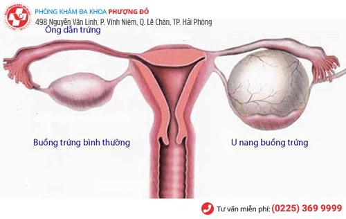 U nang buồng trứng dẫn đến những cơn đau bụng kinh dữ dội U nang buồng trứng dẫn đến những cơn đau bụng kinh dữ dội