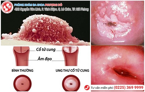 ung thư cổ tử cung