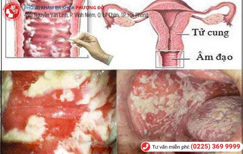 Dấu hiệu viêm cổ tử cung Dấu hiệu viêm cổ tử cung