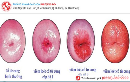 Hình ảnh viêm loét cổ tử cung Hình ảnh viêm loét cổ tử cung
