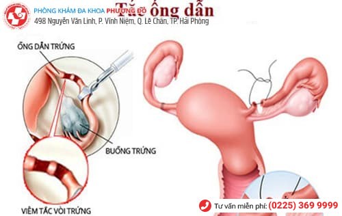 viêm ống dẫn trứng