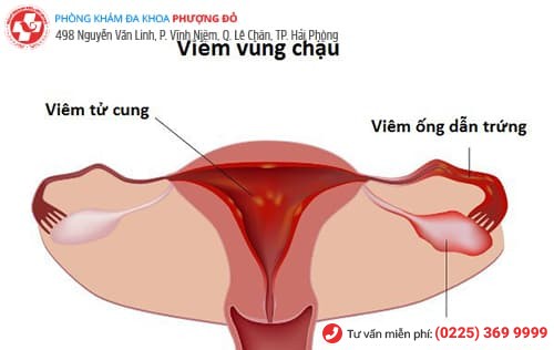viêm vùng chậu