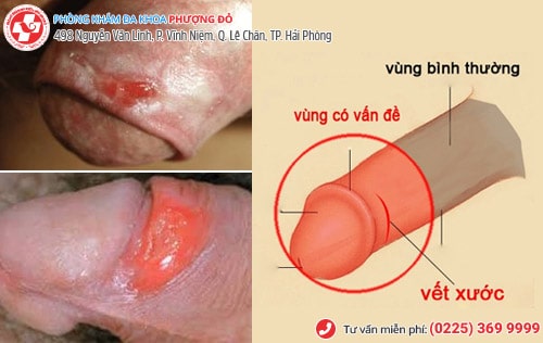 Xước vùng kín nam, nữ do đâu? Có nguy hiểm không?