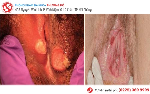 Xước vùng kín nam, nữ do đâu? Có nguy hiểm không?