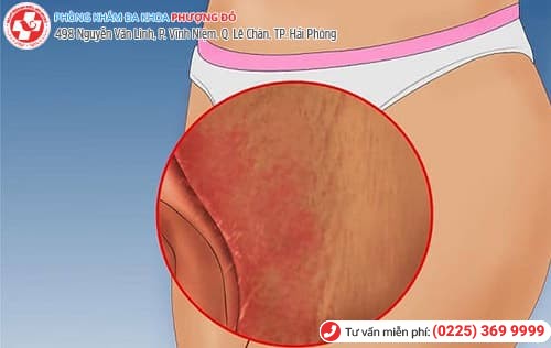 xước vùng kín xước vùng kín