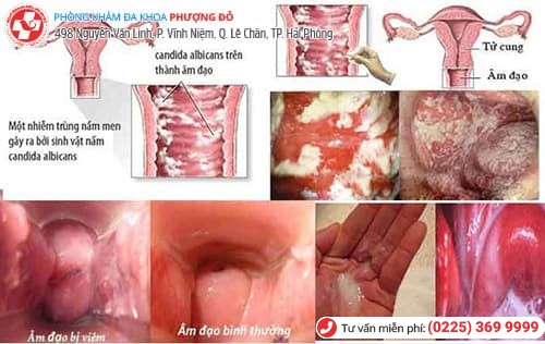 xước vùng kín gây viêm nhiễm phụ khoa xước vùng kín gây viêm nhiễm phụ khoa