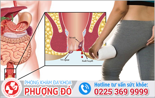 Bệnh trĩ có chết không?