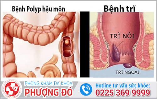 Bệnh trĩ ngoại và polyp hậu môn