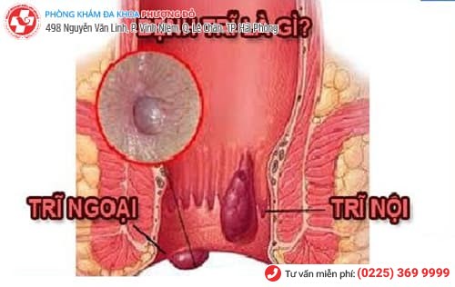 bệnh trĩ ra máu