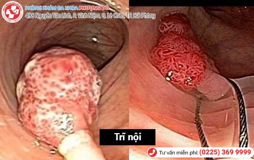 Cách phân biệt trĩ nội trĩ ngoại đơn giản, chính xác nhất Cách phân biệt trĩ nội trĩ ngoại đơn giản, chính xác nhất