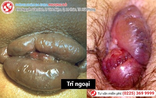 Cách phân biệt trĩ nội trĩ ngoại đơn giản, chính xác nhất Cách phân biệt trĩ nội trĩ ngoại đơn giản, chính xác nhất