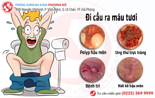 Đi cầu ra máu tươi là dấu hiệu của bệnh lý hậu môn - trực tràng Đi cầu ra máu tươi là bệnh gì?