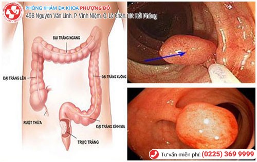 Hình ảnh Polyp hậu môn Hình ảnh Polyp hậu môn
