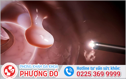 Phẫu thuật polyp hậu môn có gây đau đớn không?