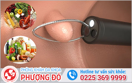 Sau khi cắt polyp hậu môn cần lưu ý gì?