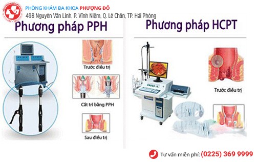 PPH, HCPT - phương pháp cắt trĩ hiệu quả hiện nay PPH, HCPT - phương pháp cắt trĩ hiệu quả hiện nay