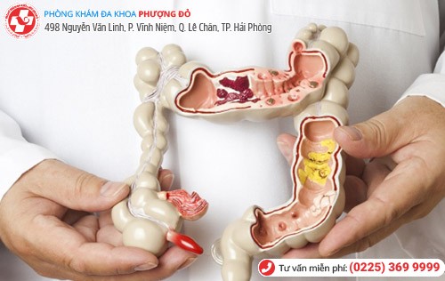 Tìm đúng phương pháp điều trị Polyp hậu môn tránh nguy cơ ung thư hậu môn