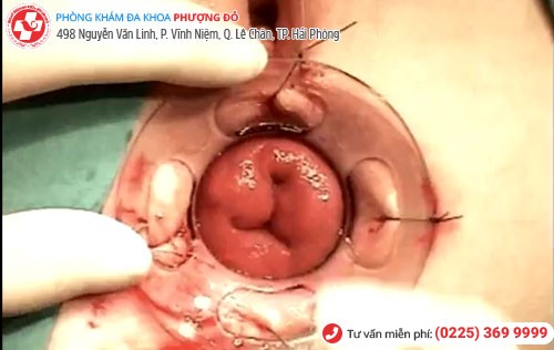 Nguy cơ sa trực tràng do Polyp Nguy cơ sa trực tràng do Polyp