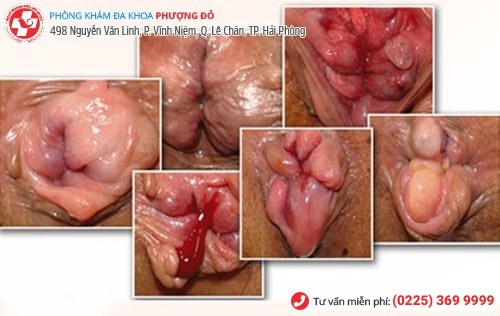 tác hại của bệnh trĩ ngoại Bệnh trĩ ngoại và những điều cần biết