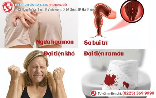 Dấu hiệu bệnh trĩ sau sinh Dấu hiệu bệnh trĩ sau sinh