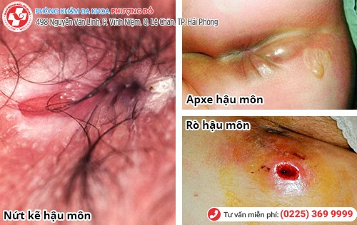 Các Bệnh Hậu Môn Trực Tràng Thường Gặp