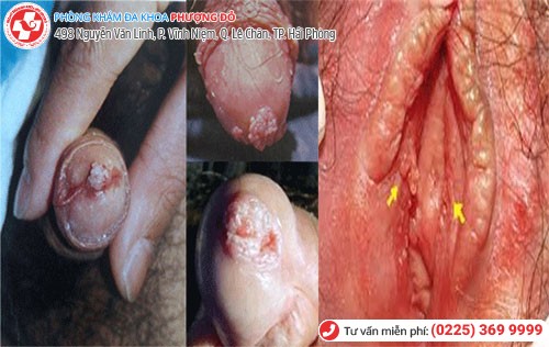 sùi mào gà ở bộ phận sinh dục nam và nữ