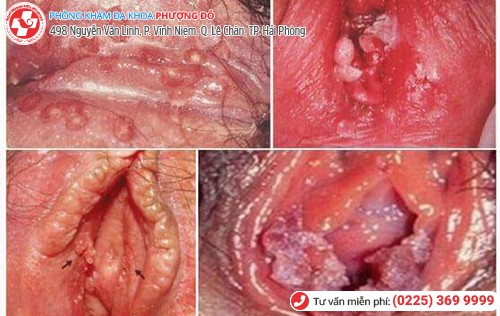 triệu chứng sùi mào gà nữ