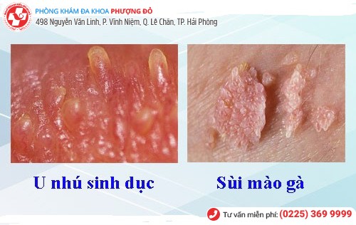 u nhú sinh dục