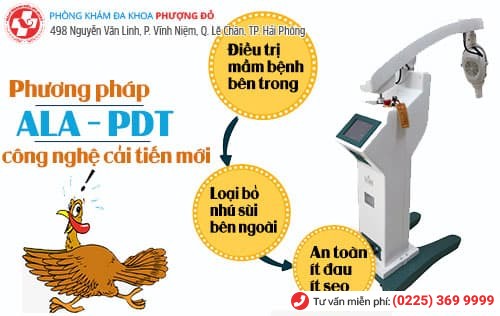 chữa sùi mào gà ở lưỡi