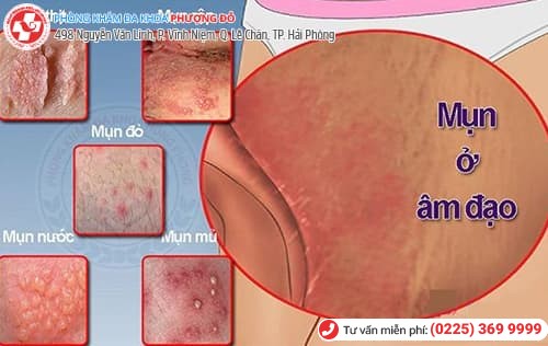 âm đạo mọc mụn
