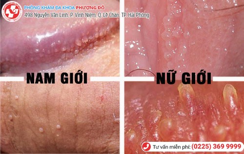 Ảnh hưởng gai sinh dục ở nam và nữ Ảnh hưởng gai sinh dục