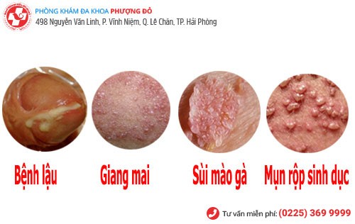 Hình ảnh bệnh hoa liễu cơ bản Hình ảnh bệnh hoa liễu cơ bản