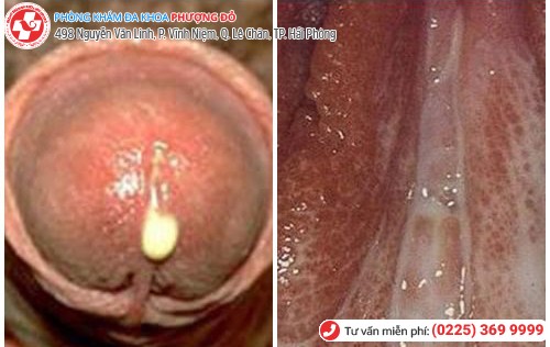 hình ảnh bệnh kim la