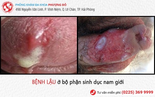 Biểu hiện bệnh lậu – đa số đều không biết đến thông tin này Biểu hiện bệnh lậu – đa số đều không biết đến thông tin này