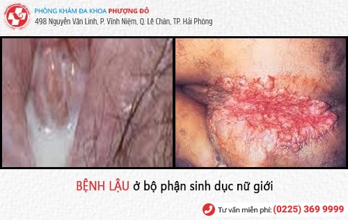 Biểu hiện bệnh lậu – đa số đều không biết đến thông tin này Biểu hiện bệnh lậu – đa số đều không biết đến thông tin này
