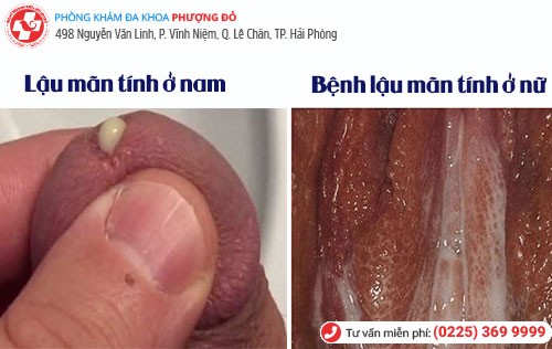 bệnh lậu mãn tính