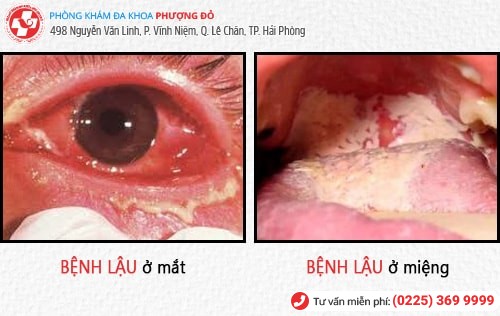 Biểu hiện bệnh lậu – đa số đều không biết đến thông tin này Biểu hiện bệnh lậu – đa số đều không biết đến thông tin này