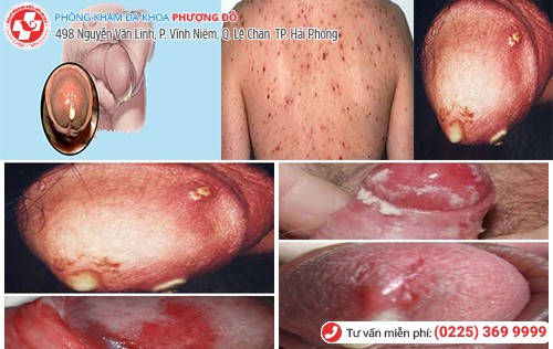 hình ảnh bệnh lậu ở nam