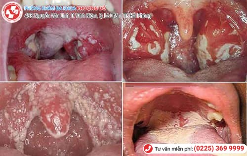 bệnh lậu ở miệng