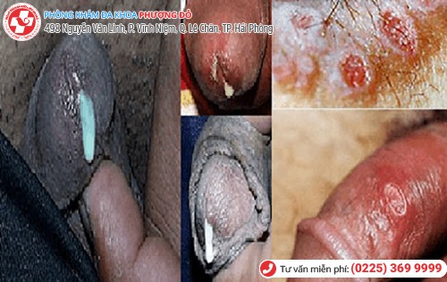 bệnh lậu ở nam giới