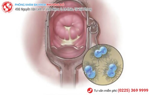 Bệnh lậu ở nữ