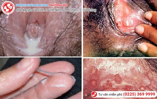 Bệnh lậu ở nữ Bệnh lậu ở nữ