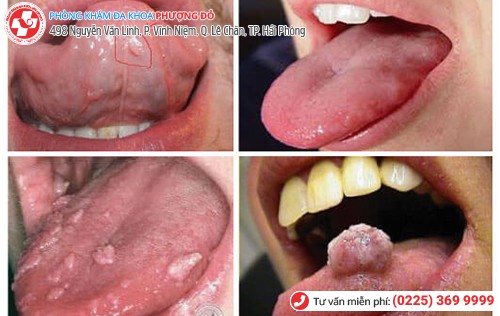 sùi mào gà ở miệng