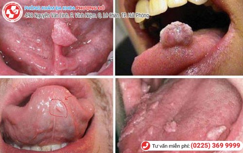 Sùi mào gà ở miệng Sùi mào gà ở miệng