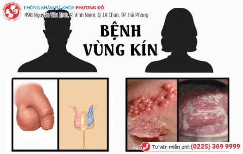 Bệnh vùng kín ở cả nam và nữ Bệnh vùng kín ở cả nam và nữ